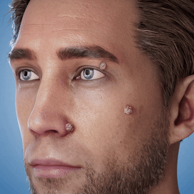 Official Brand Store | 🔥 TopSpire® 2-in-1 Microneedle & Hydrocolloid Patches | Designed for Raised Moles, Acne, Flat Warts & Skin Tags