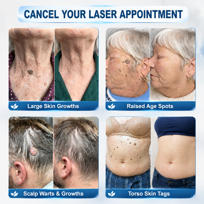✨🇨🇦 Official Canada Store | Rolimey® 7-Day Skin Tag & Blemish Roll-On – Painless & Scar-Free