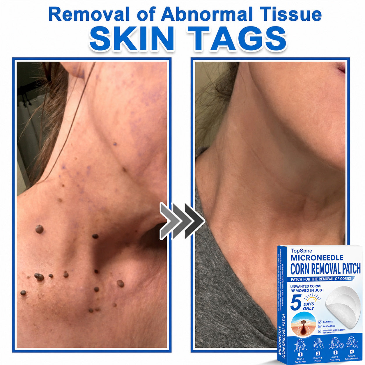 Official Brand Store | 🔥 TopSpire® 2-in-1 Microneedle & Hydrocolloid Patches | Designed for Raised Moles, Acne, Flat Warts & Skin Tags