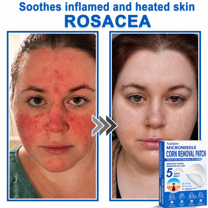 Official Brand Store | 🔥 TopSpire® 2-in-1 Microneedle & Hydrocolloid Patches | Designed for Raised Moles, Acne, Flat Warts & Skin Tags