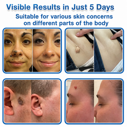 Official Brand Store | 🔥 TopSpire® 2-in-1 Microneedle & Hydrocolloid Patches | Designed for Raised Moles, Acne, Flat Warts & Skin Tags
