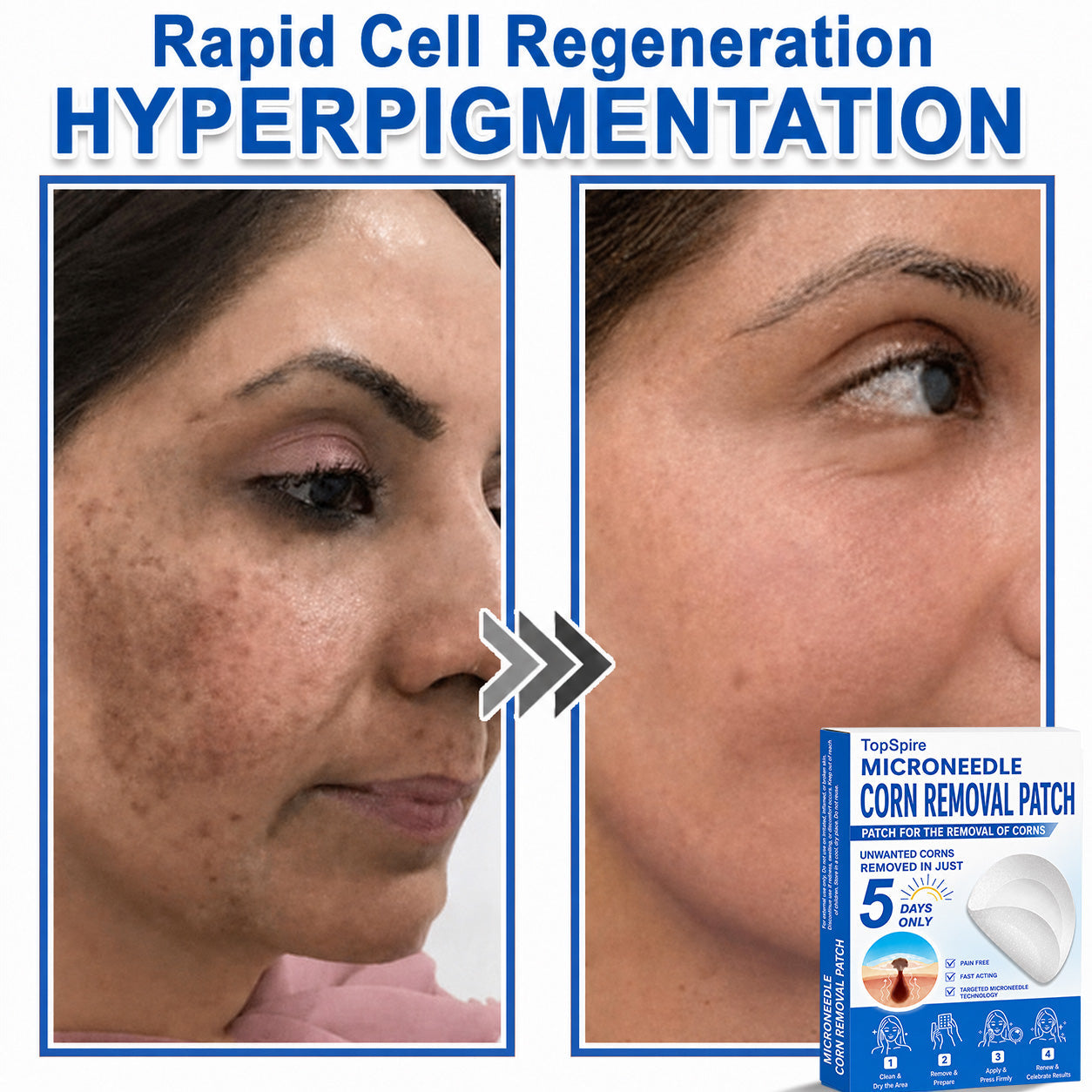 Official Brand Store | 🔥 TopSpire® 2-in-1 Microneedle & Hydrocolloid Patches | Designed for Raised Moles, Acne, Flat Warts & Skin Tags