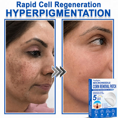 Official Brand Store | 🔥 TopSpire® 2-in-1 Microneedle & Hydrocolloid Patches | Designed for Raised Moles, Acne, Flat Warts & Skin Tags