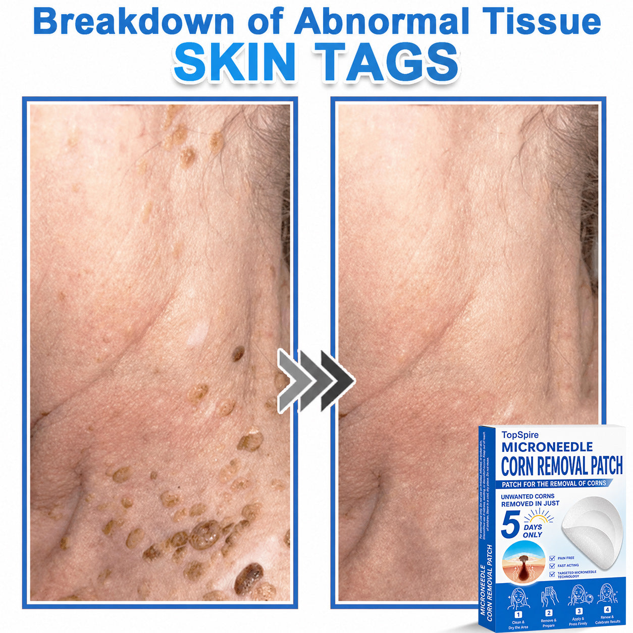 Official Brand Store | 🔥 TopSpire® 2-in-1 Microneedle & Hydrocolloid Patches | Designed for Raised Moles, Acne, Flat Warts & Skin Tags