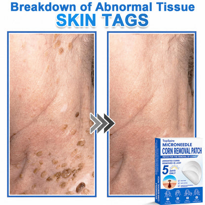 Official Brand Store | 🔥 TopSpire® 2-in-1 Microneedle & Hydrocolloid Patches | Designed for Raised Moles, Acne, Flat Warts & Skin Tags