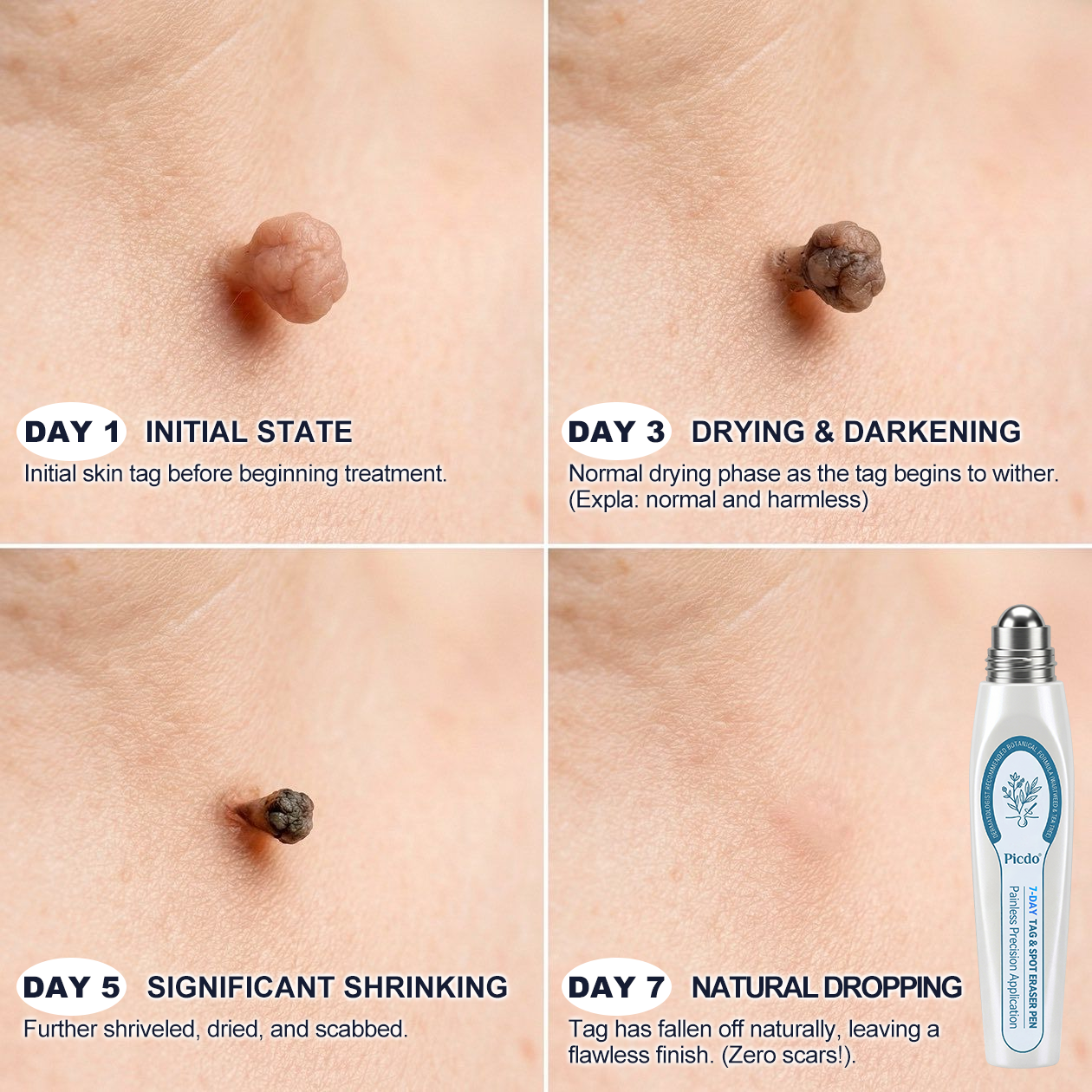 ✨🇨🇦 Official Canada Store | Rolimey® 7-Day Skin Tag & Blemish Roll-On – Painless & Scar-Free