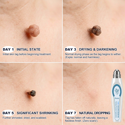 ✨🇨🇦 Official Canada Store | Rolimey® 7-Day Skin Tag & Blemish Roll-On – Painless & Scar-Free